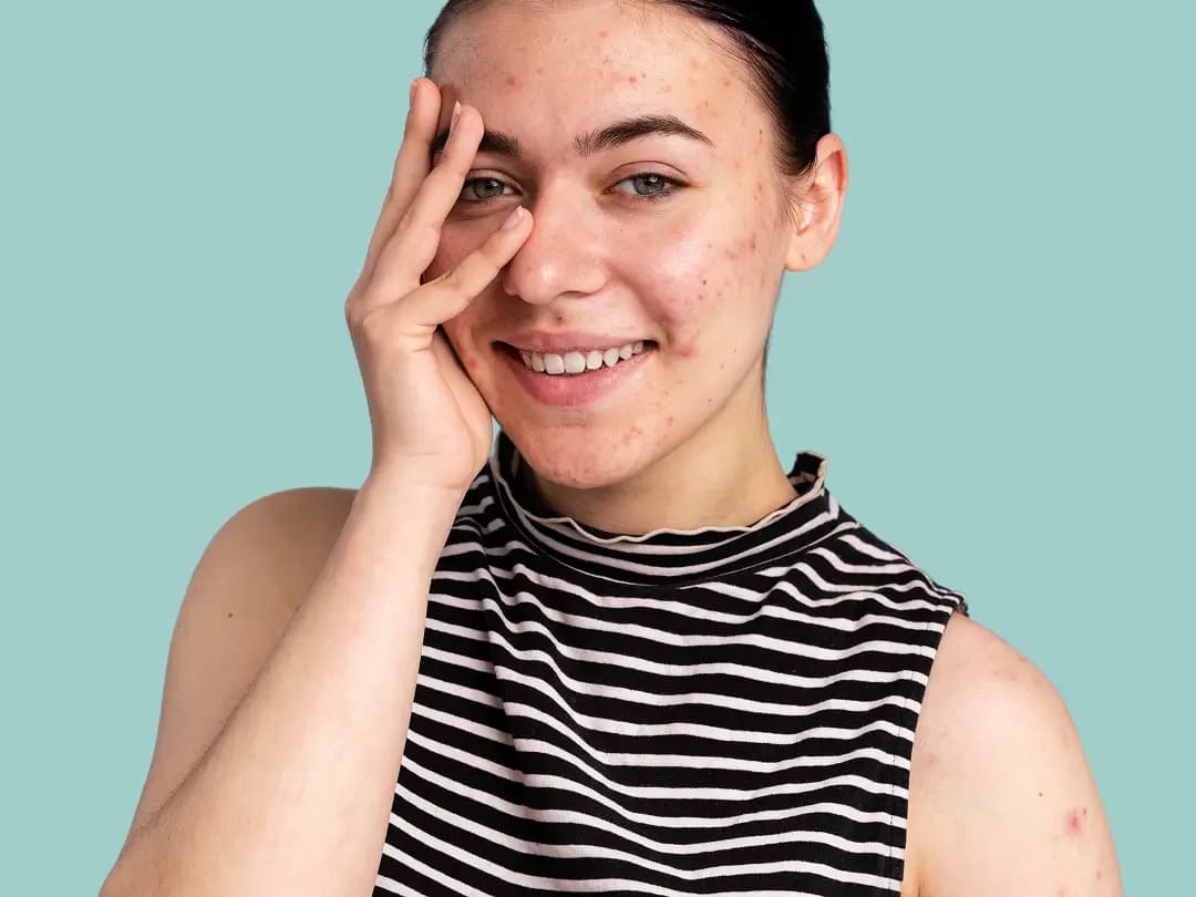 Acne treatments